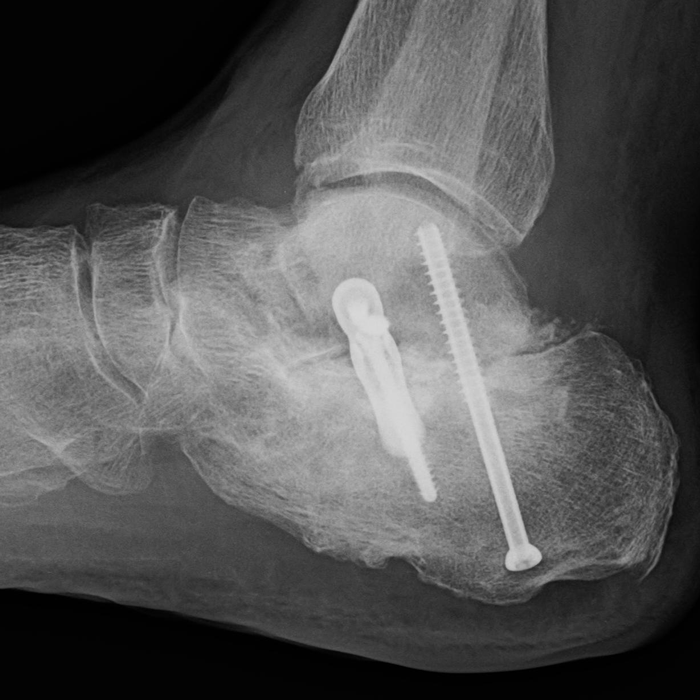 Case 1 Lateral XRay
